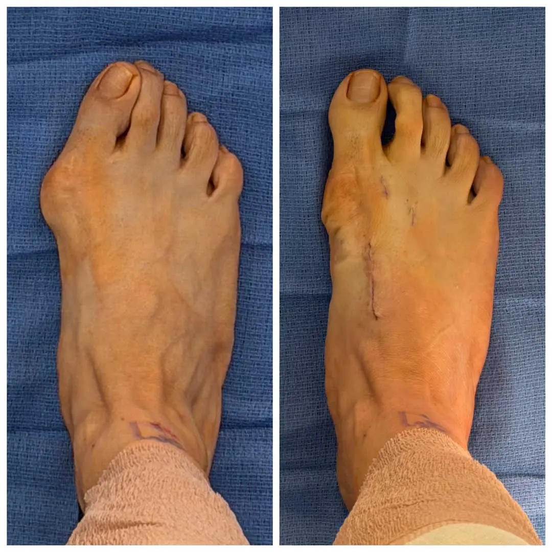 Before After Bunion Surgery