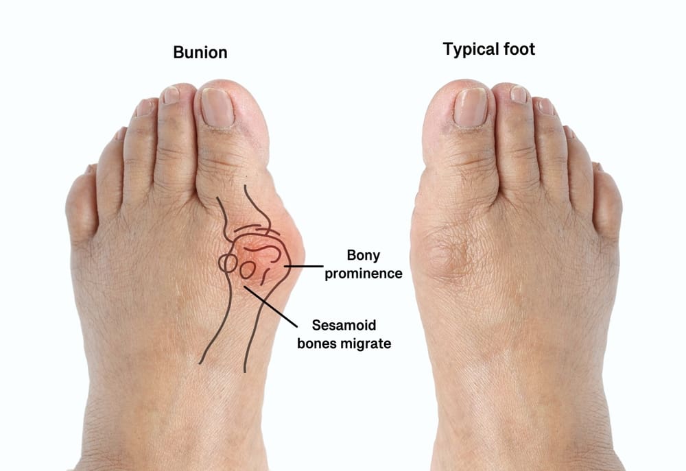 Bunion Diagram